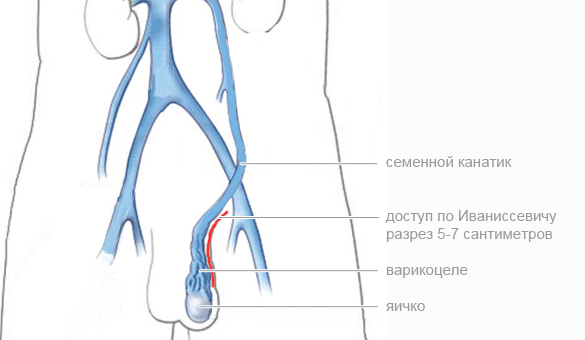 Операция по Иваниссевичу